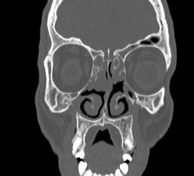 File:Aplastic maxillary sinuses (Radiopaedia 60030-67561 Coronal non-contrast 14).jpg