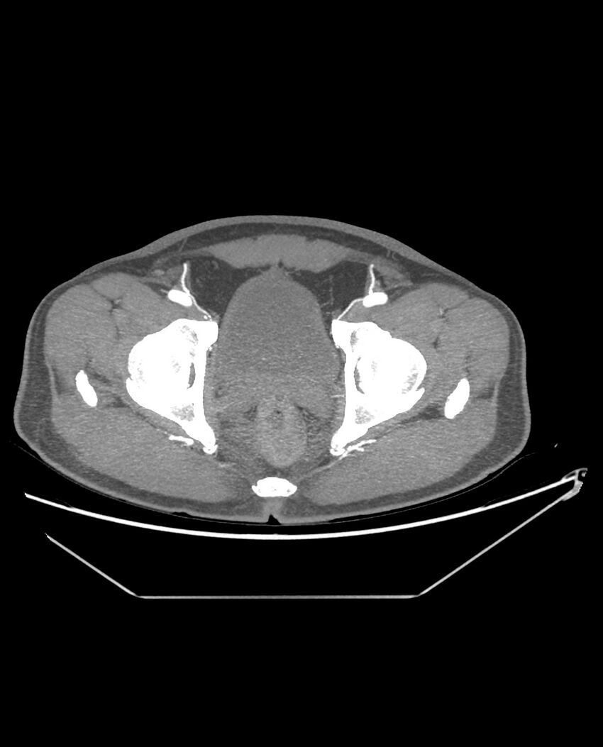 Aplastic posterior tibial arteries (Radiopaedia 84021-99249 A 97).jpg