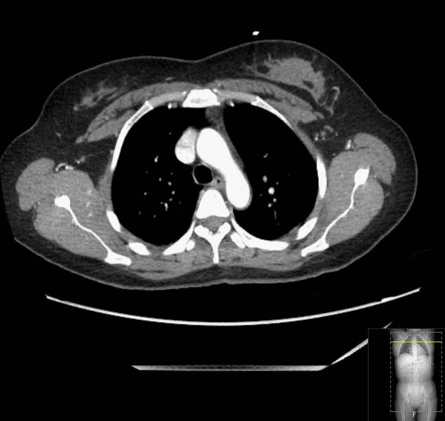 File:Appendicitis (CT angiogram) (Radiopaedia 154713-127660 Axial 218).jpg