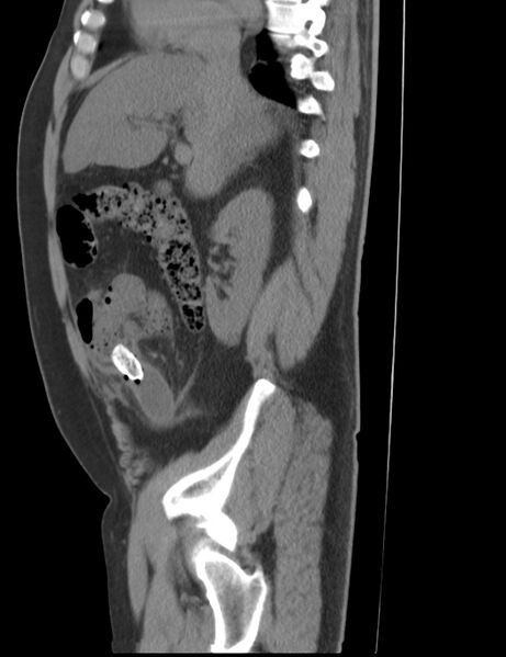 File:Appendicitis and giant appendicolith (Radiopaedia 80251-93588 C 10).jpg