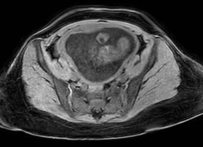 File:Appendicitis in gravida (MRI) (Radiopaedia 89433-106395 Axial DIXON 115).jpg