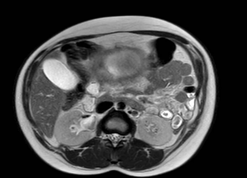 File:Appendicitis in gravida (MRI) (Radiopaedia 89433-106395 Axial T2 25).jpg