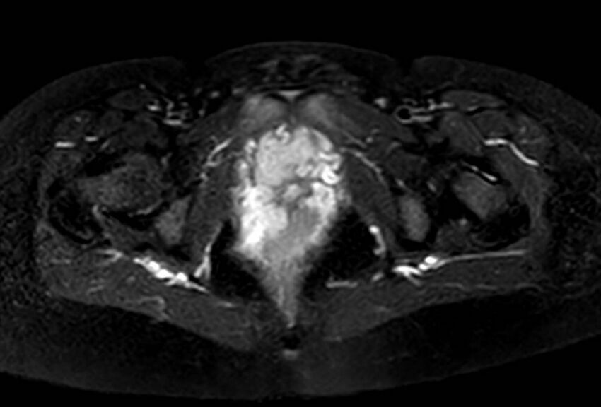 Appendicitis in gravida (MRI) (Radiopaedia 89433-106395 Axial T2 SPAIR 74).jpg