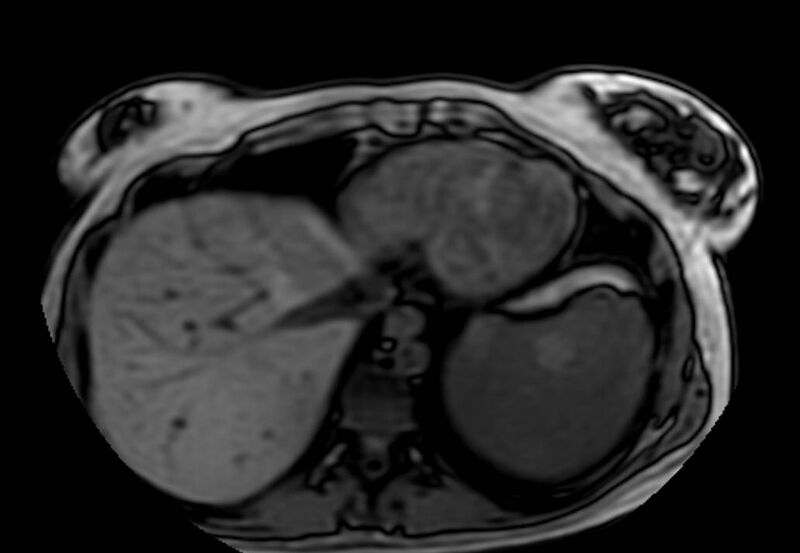 File:Appendicitis in gravida (MRI) (Radiopaedia 89433-106395 D 2).jpg