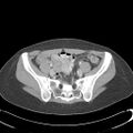 Appendicitis with minimal stranding but appendicolith (Radiopaedia 29035-29397 A 64).jpg
