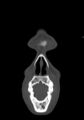 Arrow injury to the head (Radiopaedia 75266-86388 Coronal bone window 16).jpg