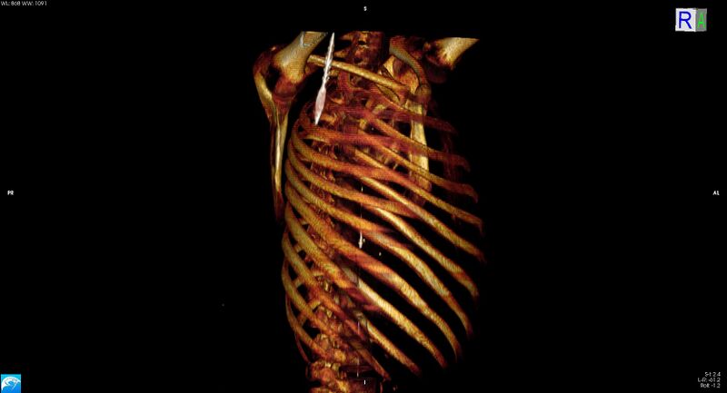 File:Arrow injury to the neck (Radiopaedia 75225-86323 3D bone 35).jpg