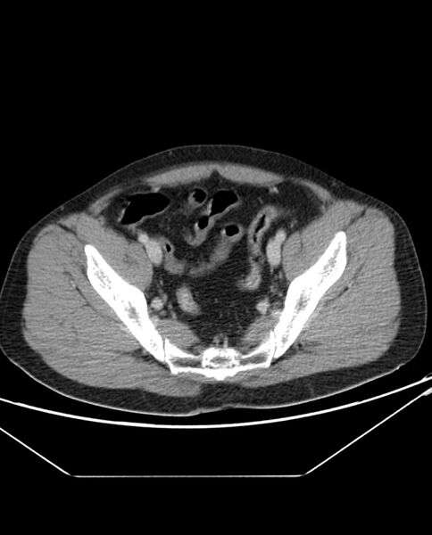 File:Arterial occlusive mesenteric ischemia (Radiopaedia 84641-100054 A 101).jpg