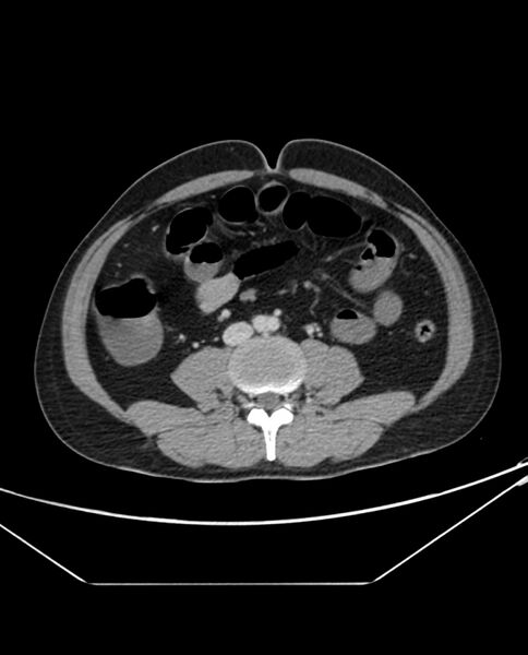 File:Arterial occlusive mesenteric ischemia (Radiopaedia 84641-100054 A 68).jpg