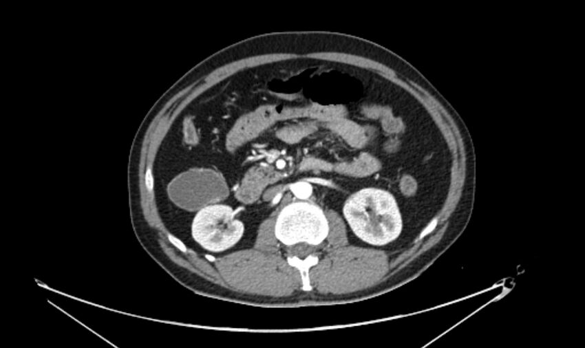 Arterial occlusive mesenteric ischemia (Radiopaedia 84641-100060 A 57).jpg
