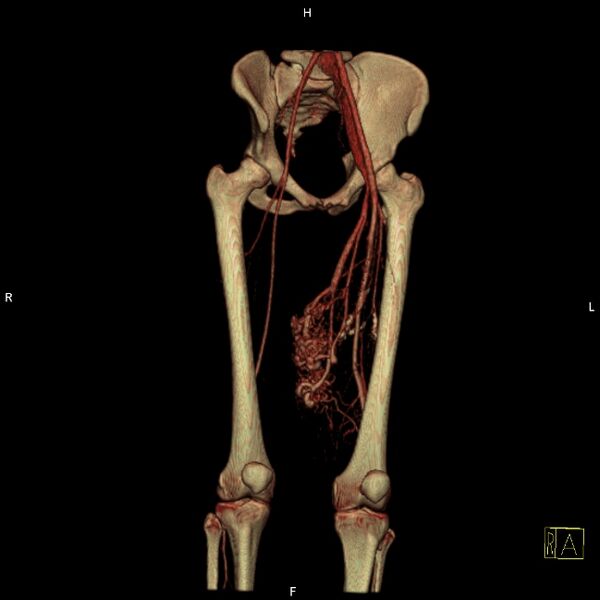 File:Arteriovenous malformation - thigh (Radiopaedia 14948-14883 3D reformat 11).jpg