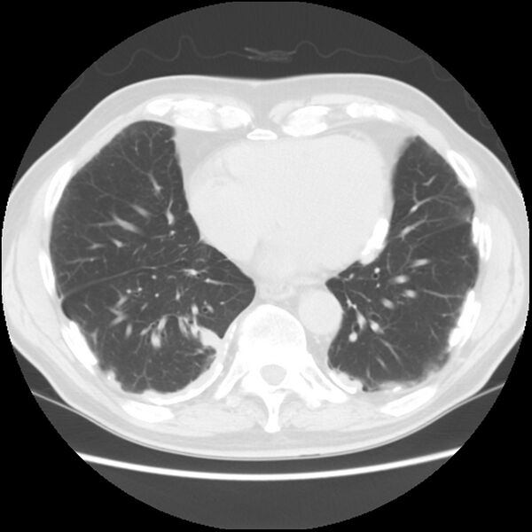 File:Asbestos-related pleural plaques (Radiopaedia 39069-41255 Axial lung window 50).jpg