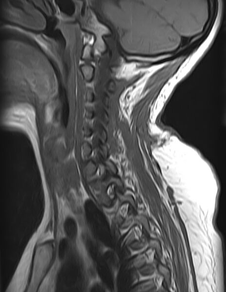 File:Astrocytoma - spinal cord (Radiopaedia 69769-79758 Sagittal T1 4).jpg