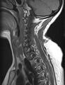 Astrocytoma - spinal cord (Radiopaedia 69769-79758 Sagittal T1 4).jpg