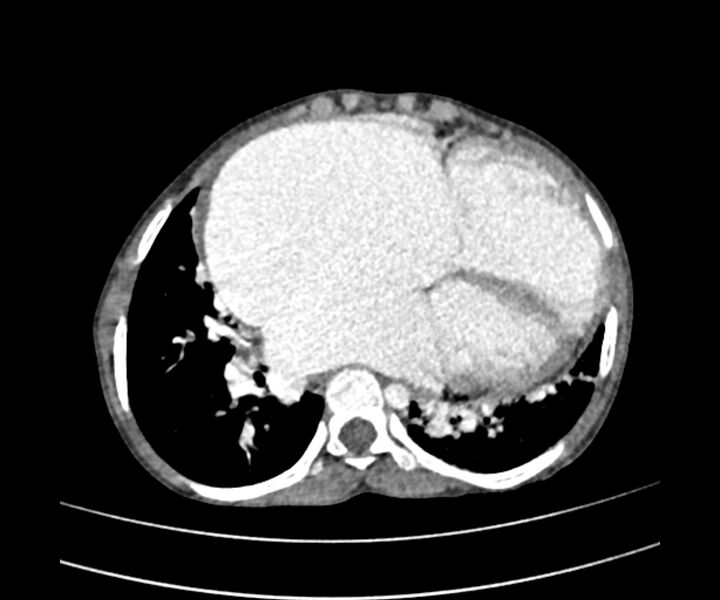 File:Atrial septal defect complicated by Eisenmenger syndrome (Radiopaedia 53707-59768 Axial C+ CTPA 21).jpg