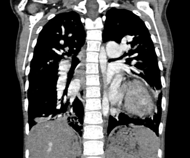 File:Atrial septal defect complicated by Eisenmenger syndrome (Radiopaedia 53707-59768 Coronal C+ CTPA 15).jpg