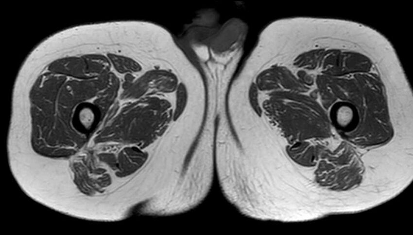 Atypical lipomatous tumor - thigh (Radiopaedia 68975-78734 Axial T1 69).jpg