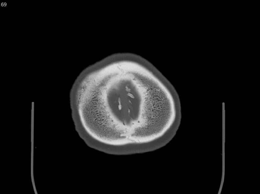 Atypical meningioma - intraosseous (Radiopaedia 64915-73867 Axial C+ bone window 69).jpg