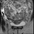 Atypical retroperitoneal lymphocoeles with large leiomyoma of uterus (Radiopaedia 32084-33027 Coronal T2 11).jpg