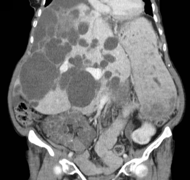 File:Autosomal dominant polycystic kidney disease (Radiopaedia 16777-16490 B 19).jpg