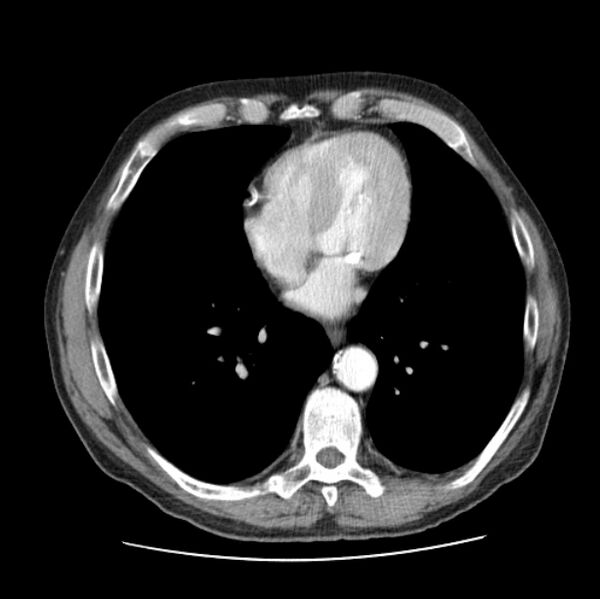 File:Autosomal dominant polycystic kidney disease (Radiopaedia 27851-28094 B 40).jpg