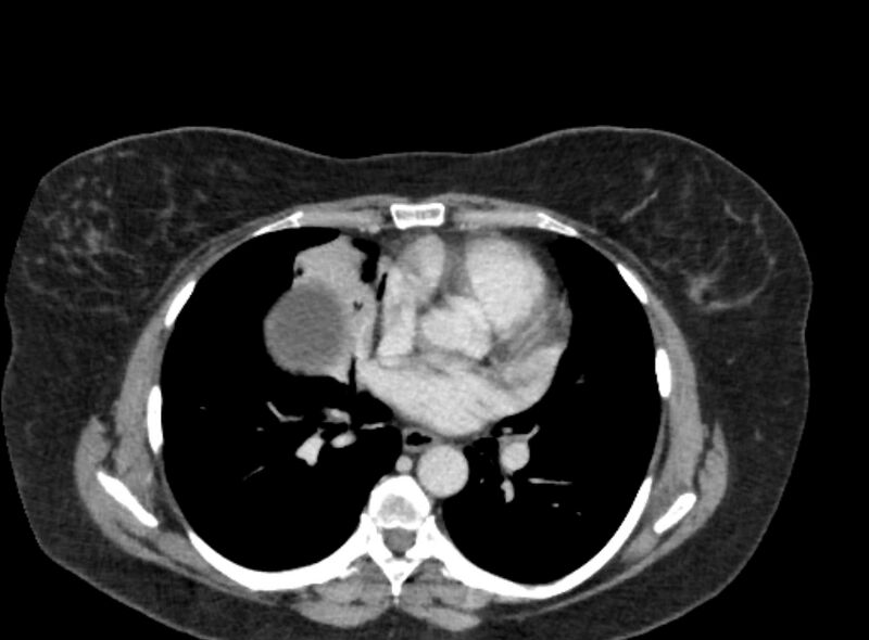 File:Autosomal dominant polycystic kidney disease (Radiopaedia 57124-64017 A 3).jpg