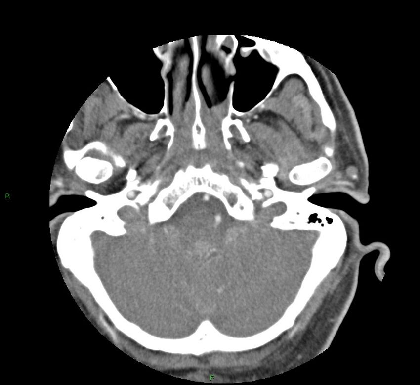 Basal ganglia hemorrhage (Radiopaedia 58763-65985 D 34).jpg