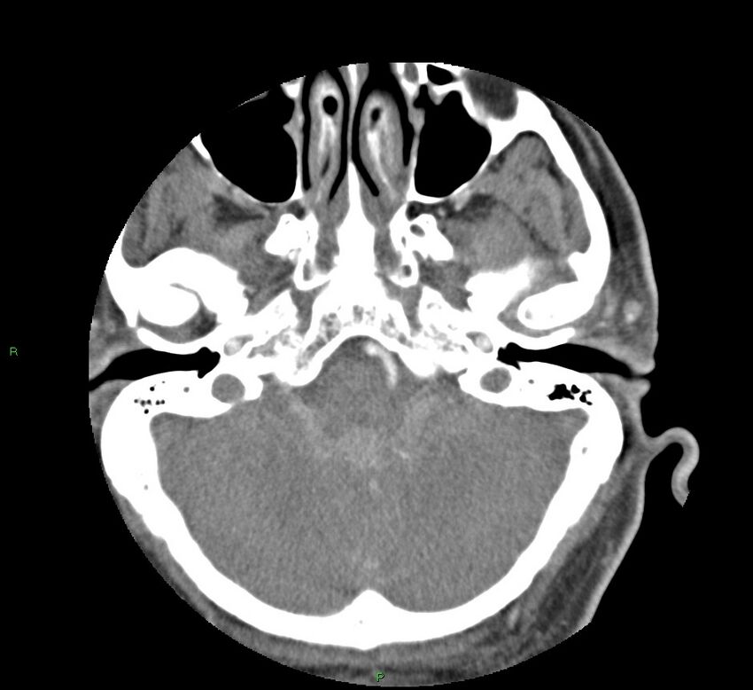 Basal ganglia hemorrhage (Radiopaedia 58763-65985 D 38).jpg