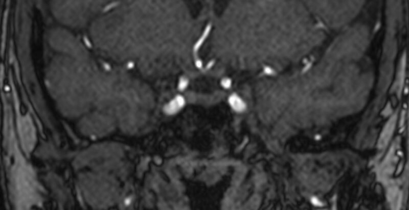 File:Basilar artery fenestration (Radiopaedia 74537-85455 Coronal MRA TOF 2).jpg