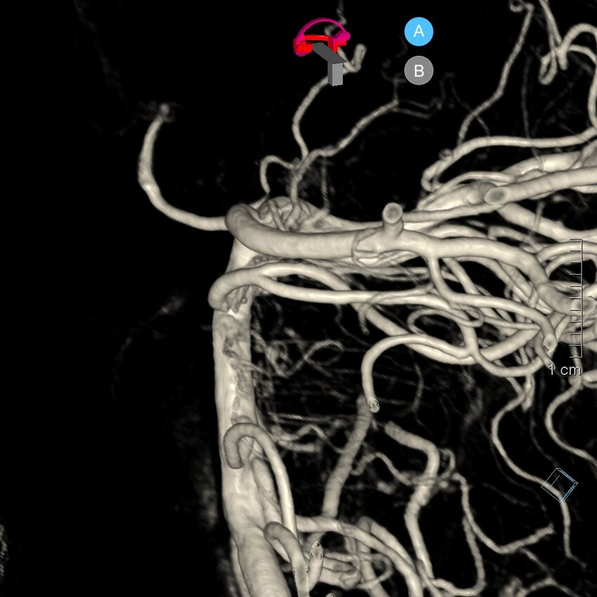 Basilar artery perforator aneurysm (Radiopaedia 82455-97734 3D view left VA 179).jpg