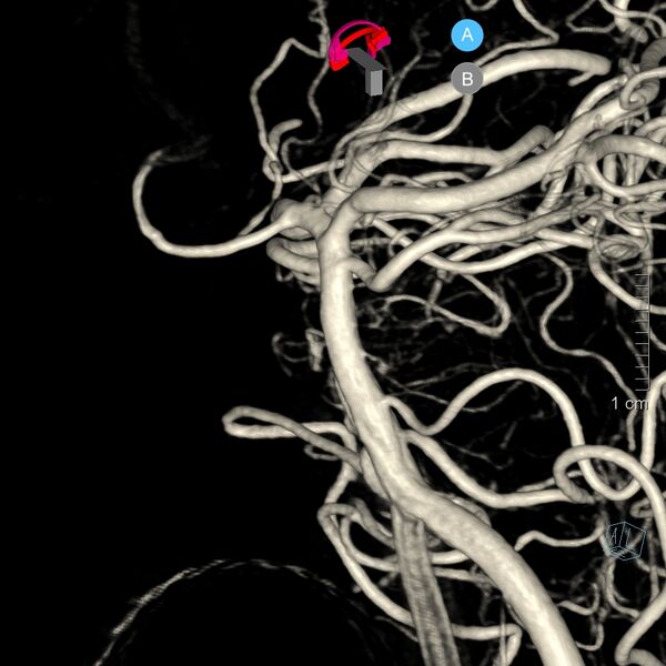 File:Basilar artery perforator aneurysm (Radiopaedia 82455-97734 3D view left VA 29).jpg