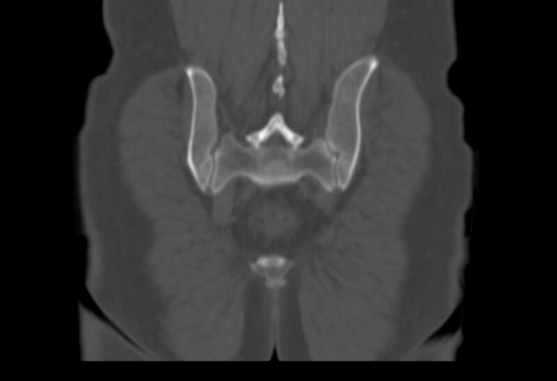 File:Bertolotti syndrome (Radiopaedia 58974-66235 Coronal bone window 5).jpg