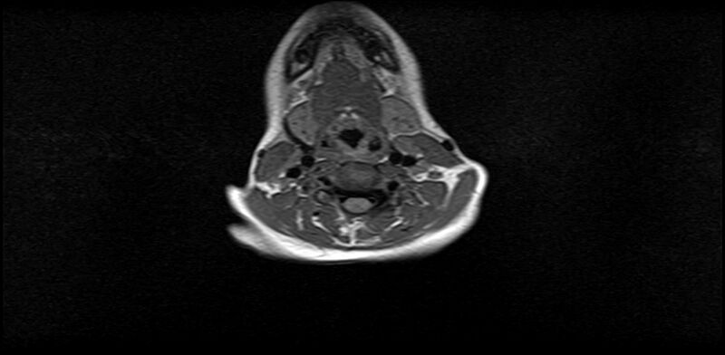 File:Bilateral Sprengel deformity with Klippel-Feil syndrome (Radiopaedia 66395-75650 Axial T1 12).jpg