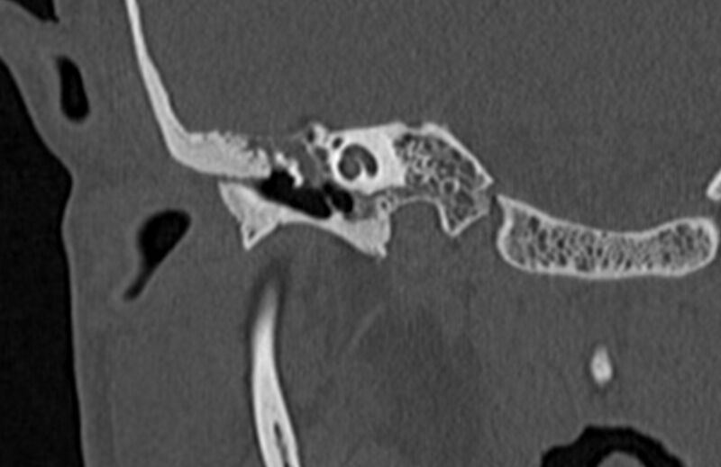 File:Bilateral cholesteatoma (Radiopaedia 54898-61172 Coronal bone window 26).jpg
