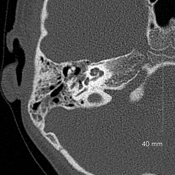 File:Bilateral grommets (Radiopaedia 47710-52404 Axial bone window 38).jpg