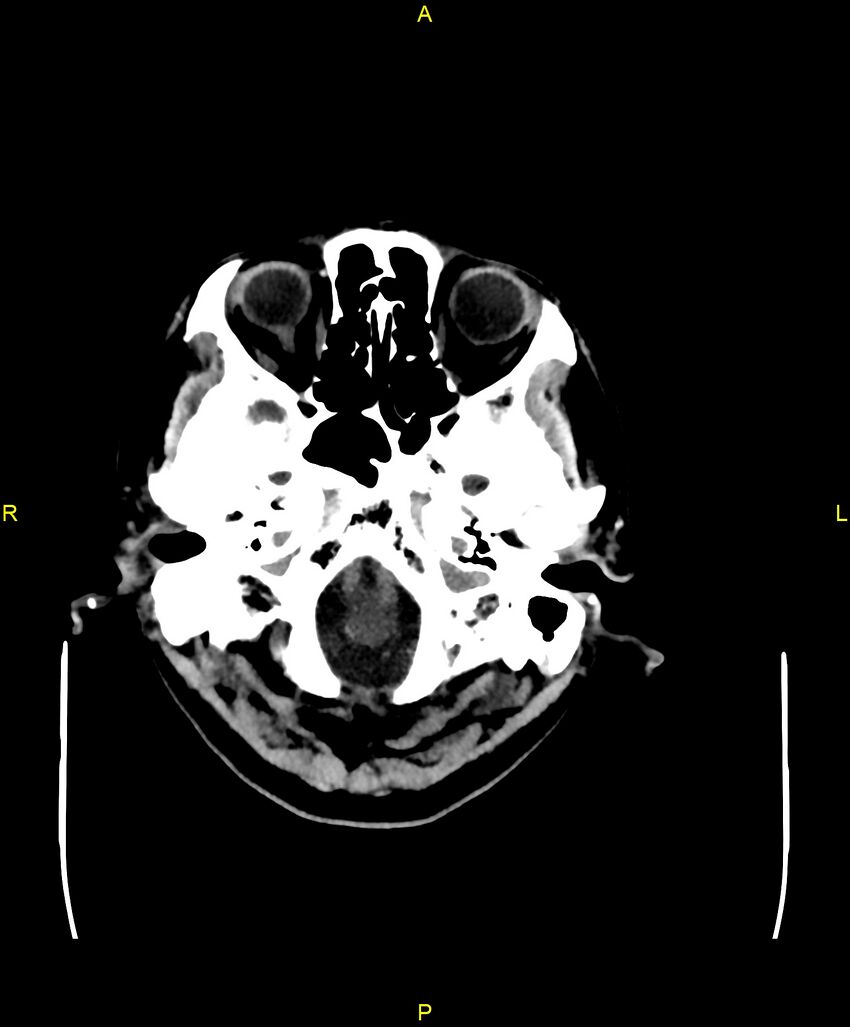 Bilateral isodense subdural hematomas (Radiopaedia 88621-105325 Axial non-contrast 12).jpg