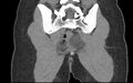 Bilateral mature cystic ovarian teratoma (Radiopaedia 88821-105592 Coronal non-contrast 36).jpg