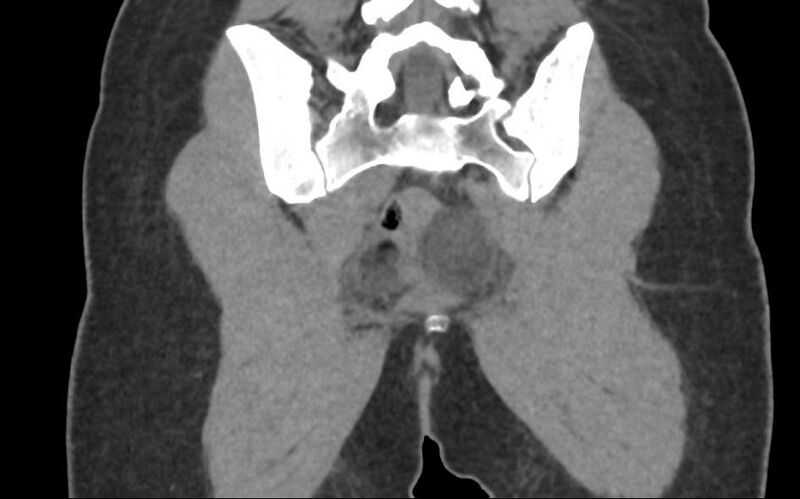 File:Bilateral mature cystic ovarian teratoma (Radiopaedia 88821-105592 Coronal non-contrast 36).jpg