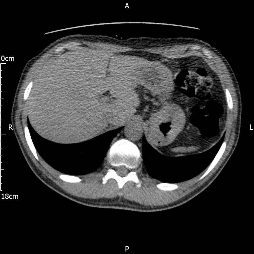 Bilateral medullary nephrocalcinosis with ureteric calculi (Radiopaedia 71269-81569 Axial non-contrast 14).jpg
