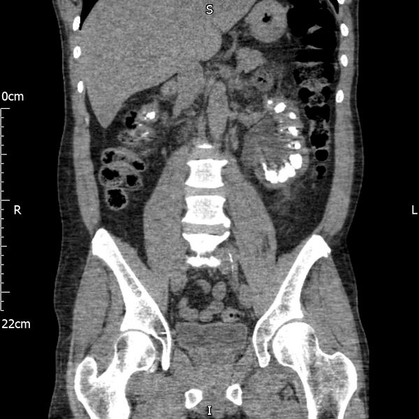 File:Bilateral medullary nephrocalcinosis with ureteric calculi (Radiopaedia 71269-81569 Coronal non-contrast 37).jpg