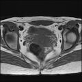 Bilateral ovarian endometriomas (Radiopaedia 87085-103347 Axial T1 14).jpg