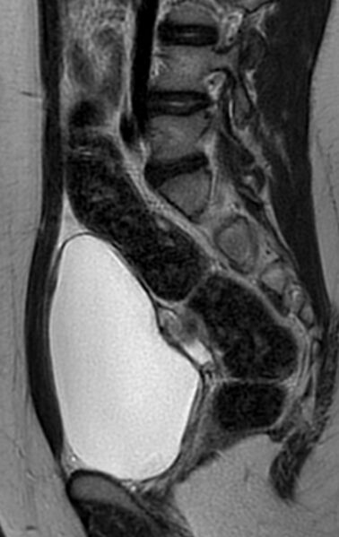 File:Bilateral ovarian fibrothecomas - adolescent (Radiopaedia 86604-102707 Sagittal T2 14).jpg
