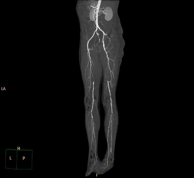 File:Bilateral superficial femoral arterial occlusion (Radiopaedia 25682-25857 3D MIP 16).jpg