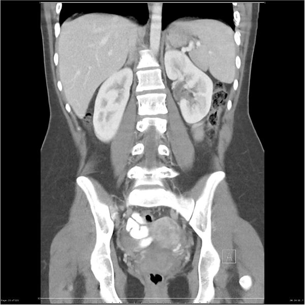 File:Bilateral ureteritis and cystitis (Radiopaedia 25340-25594 B 25).jpg