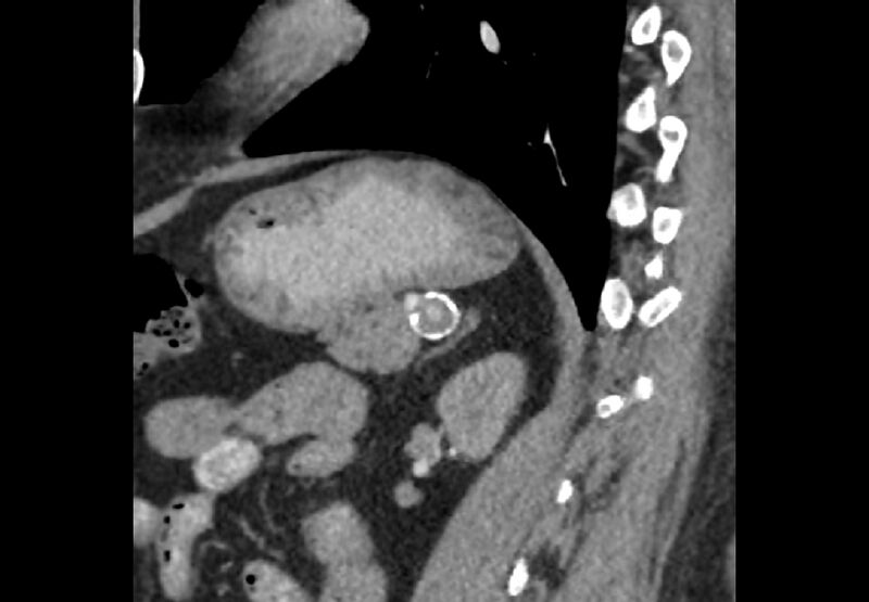 File:Bilateral urolithiasis with incidentally detected splenic artery aneurysm and left inferior vena cava (Radiopaedia 44467-48127 Ob. Sag. C+ Art. 28).jpg