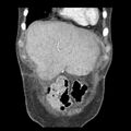Biliary necrosis - liver transplant (Radiopaedia 21876-21846 C 5).jpg