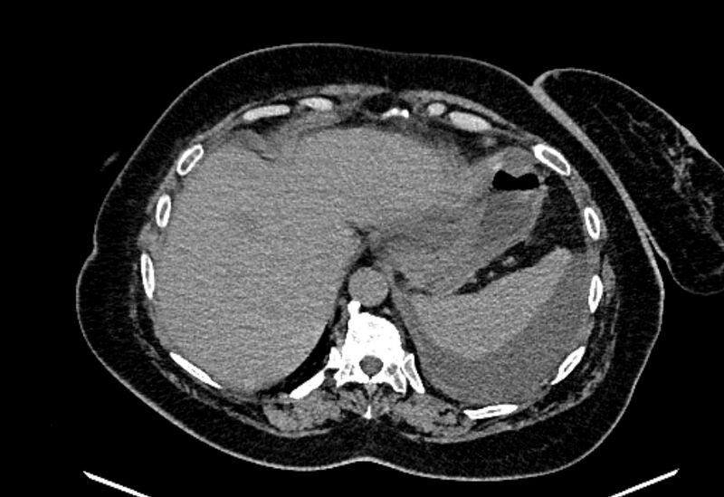 File:Biliary pancreatitis (Radiopaedia 72289-82823 Axial non-contrast 58).jpg