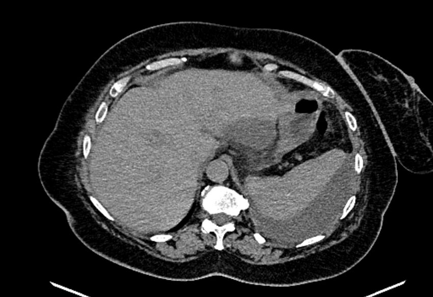 Biliary pancreatitis (Radiopaedia 72289-82823 Axial non-contrast 65).jpg