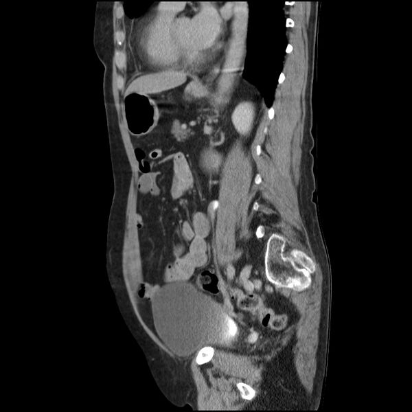 File:Bladder tumor detected on trauma CT (Radiopaedia 51809-57609 E 28).jpg