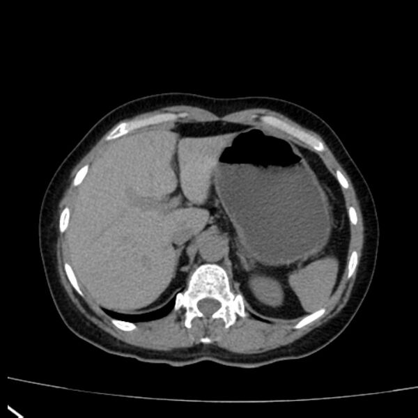 File:Bosniak renal cyst - type I (Radiopaedia 27479-27675 Axial non-contrast 19).jpg